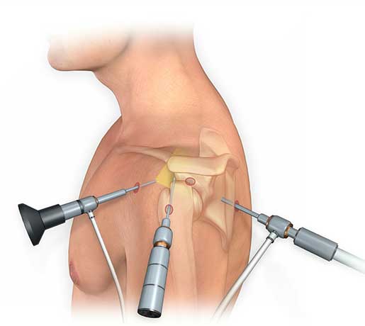 Cirugía artroscópica