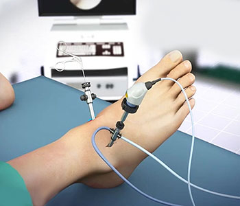 Cirugía percutánea del pie